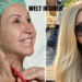 carmen geiss facelift